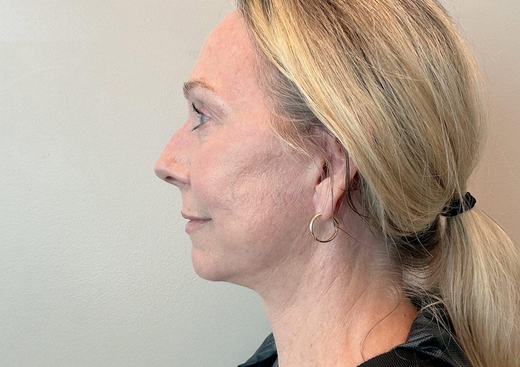 An After Photo of a Facelift with Neck Lift and Brow Lift Plastic Surgery by Dr. David Santos in Seattle and Tacoma