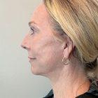 An After Photo of a Facelift with Neck Lift and Brow Lift Plastic Surgery by Dr. David Santos in Seattle and Tacoma