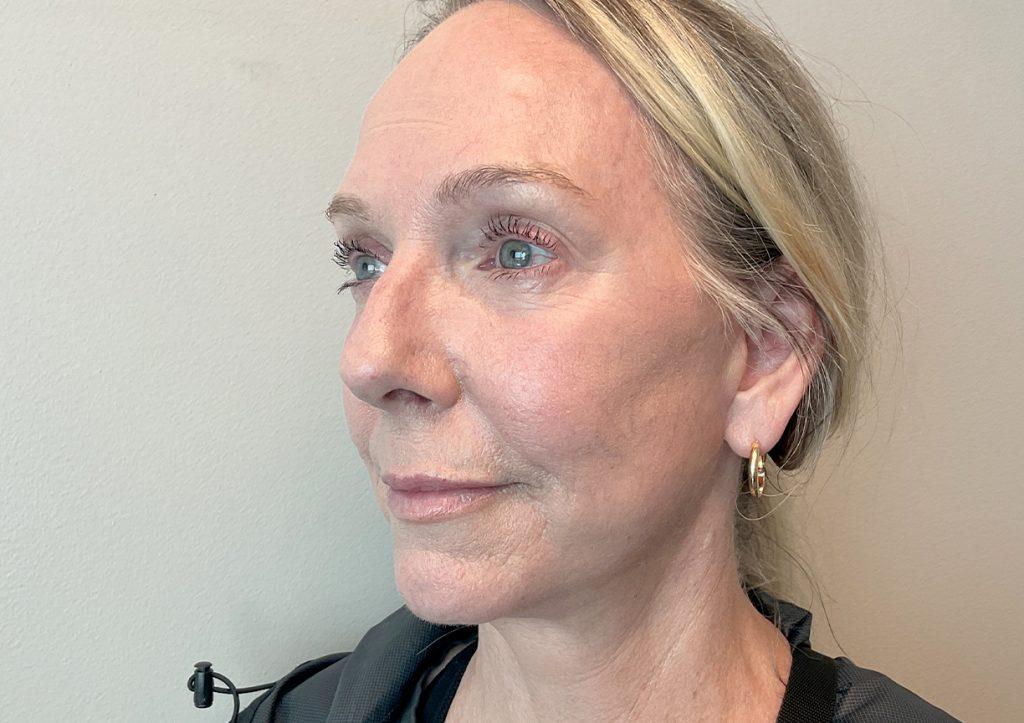 An After Photo of a Facelift with Neck Lift and Brow Lift Plastic Surgery by Dr. David Santos in Seattle and Tacoma