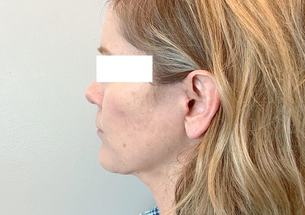 An After Photo of a Facelift with Neck Lift Plastic Surgery by Dr. David Santos in Seattle and Tacoma