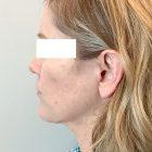 An After Photo of a Facelift with Neck Lift Plastic Surgery by Dr. David Santos in Seattle and Tacoma