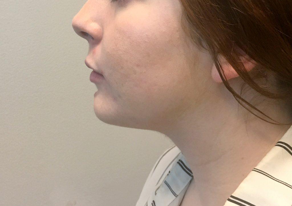 An After Photo of Chin Liposuction Plastic Surgery by Dr. Craig Jonov in Seattle and Tacoma