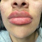 An After Photo of Cheek Filler Injections in Seattle and Tacoma