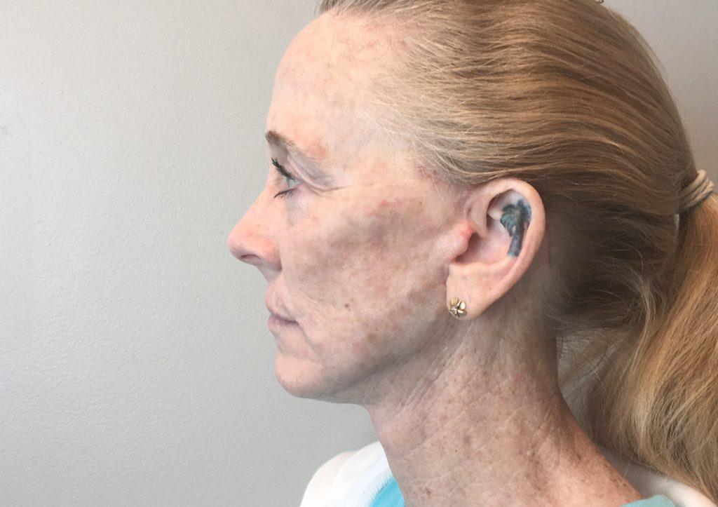 An After Photo of Mini Facelift Plastic Surgery by Dr. David Santos in Seattle and Tacoma