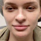 An After Photo of Cheek Filler in Seattle and Tacoma