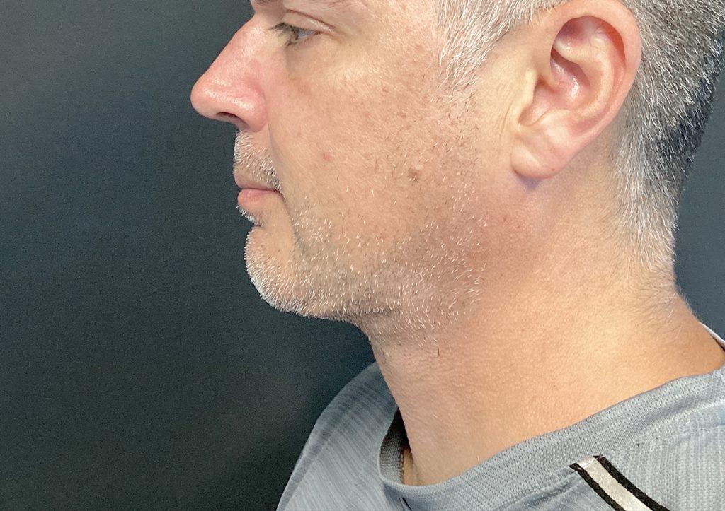 An After Photo of Chin Liposuction & Chin Augmentation Plastic Surgery by Dr. Craig Jonov in Seattle and Tacoma