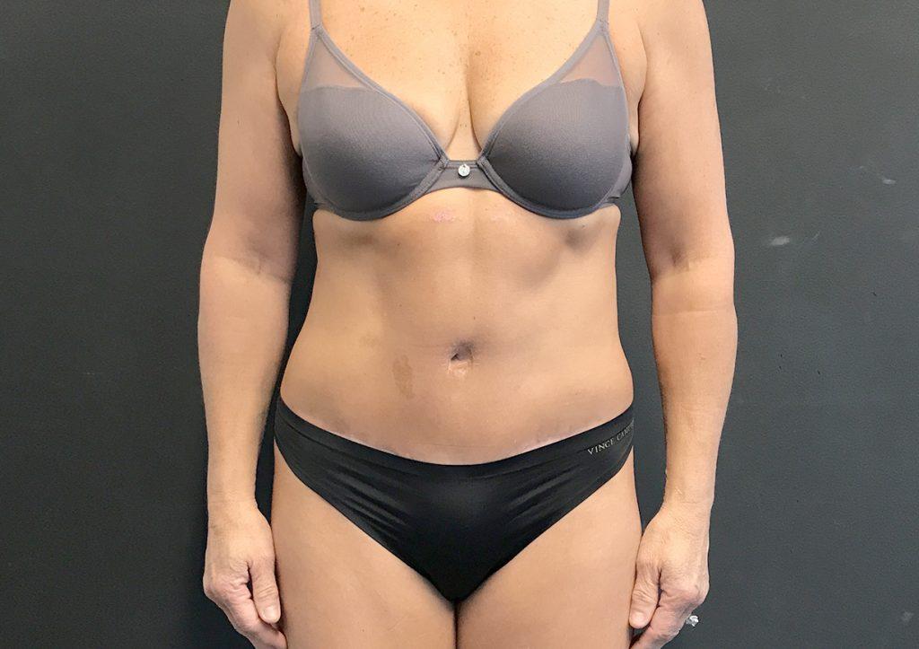 An After Photo of a Tummy Tuck Plastic Surgery by Dr. Craig Jonov in Seattle and Tacoma