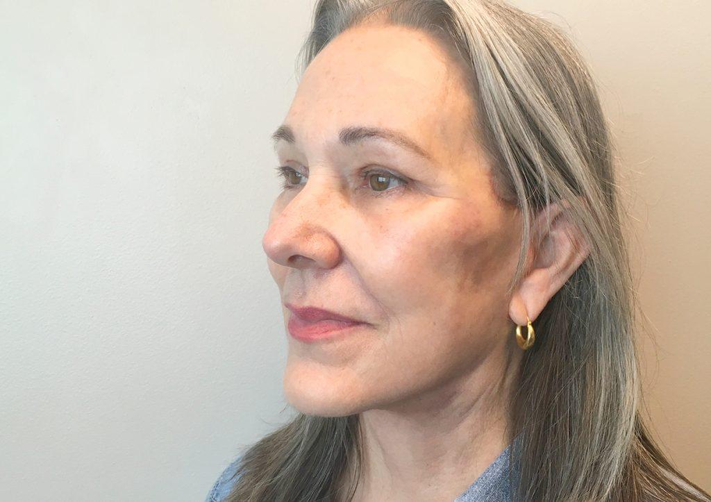 An After Photo of a Facelift Plastic Surgery by Dr. David Santos in Seattle and Tacoma