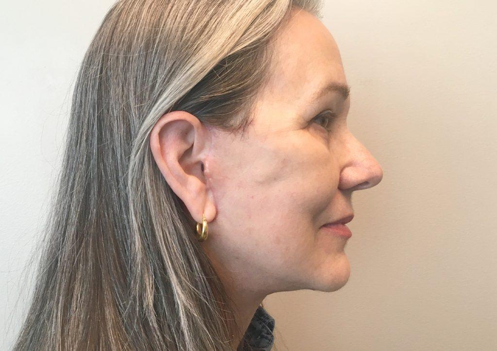 An After Photo of a Facelift Plastic Surgery by Dr. David Santos in Seattle and Tacoma