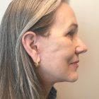 An After Photo of a Facelift Plastic Surgery by Dr. David Santos in Seattle and Tacoma