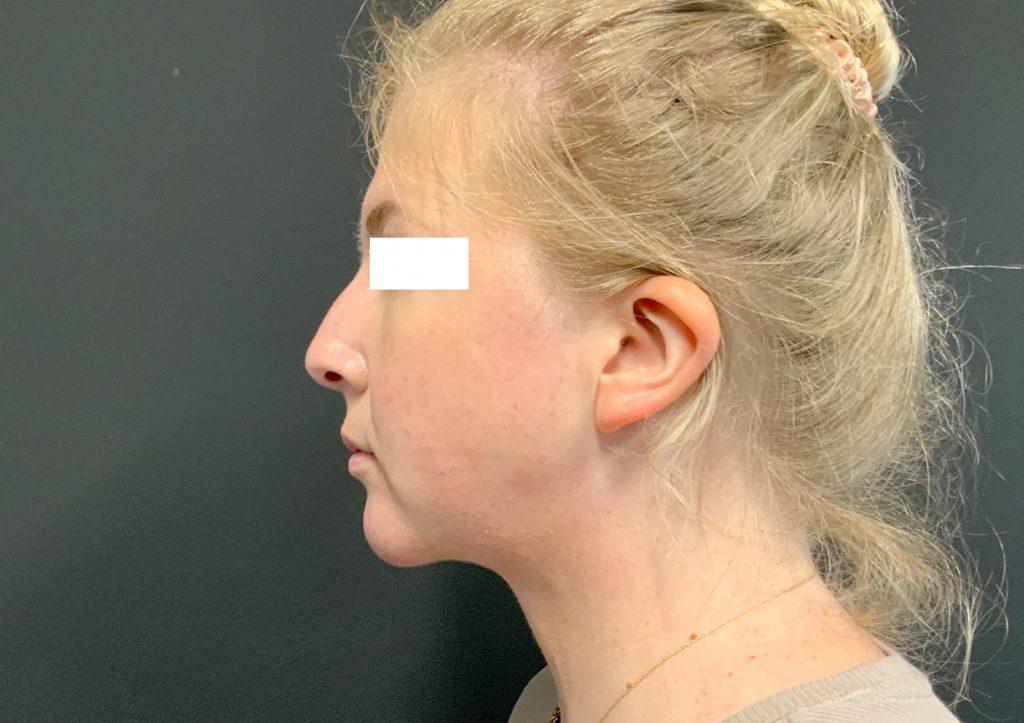 An After Photo of Chin Liposuction Plastic Surgery by Dr. Craig Jonov in Seattle and Tacoma