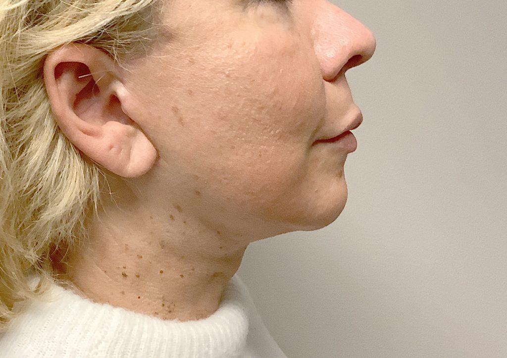 An After Photo of a Facelift & Neck Lift Plastic Surgery by Dr. David Santos in Seattle and Tacoma