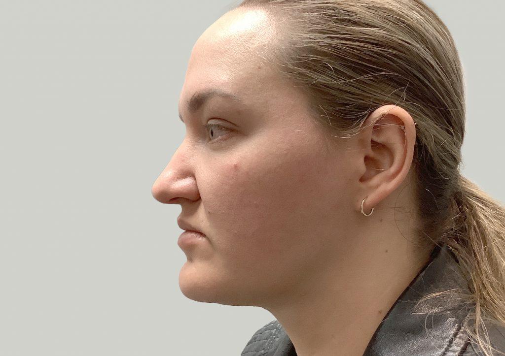 An After Photo of Chin Liposuction Plastic Surgery by Dr. David Santos in Seattle and Tacoma