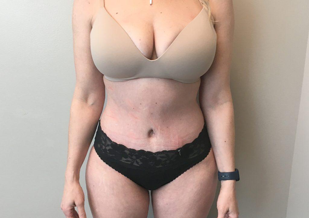 An After Photo of a Tummy Tuck Plastic Surgery by Dr. Craig Jonov in Seattle and Tacoma