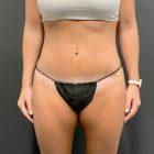 An After Photo of a Tummy Tuck Plastic Surgery by Dr. Craig Jonov in Seattle and Tacoma