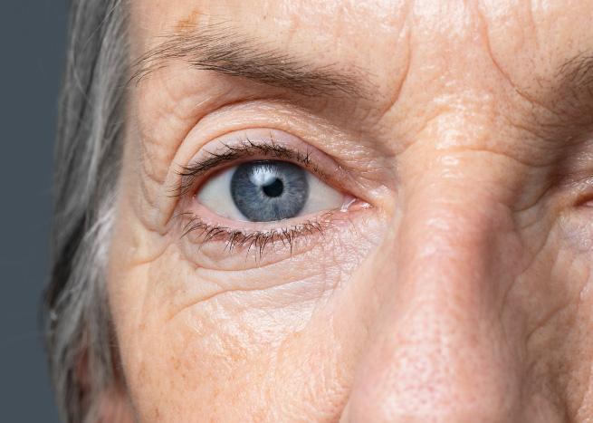 Upper Blepharoplasty