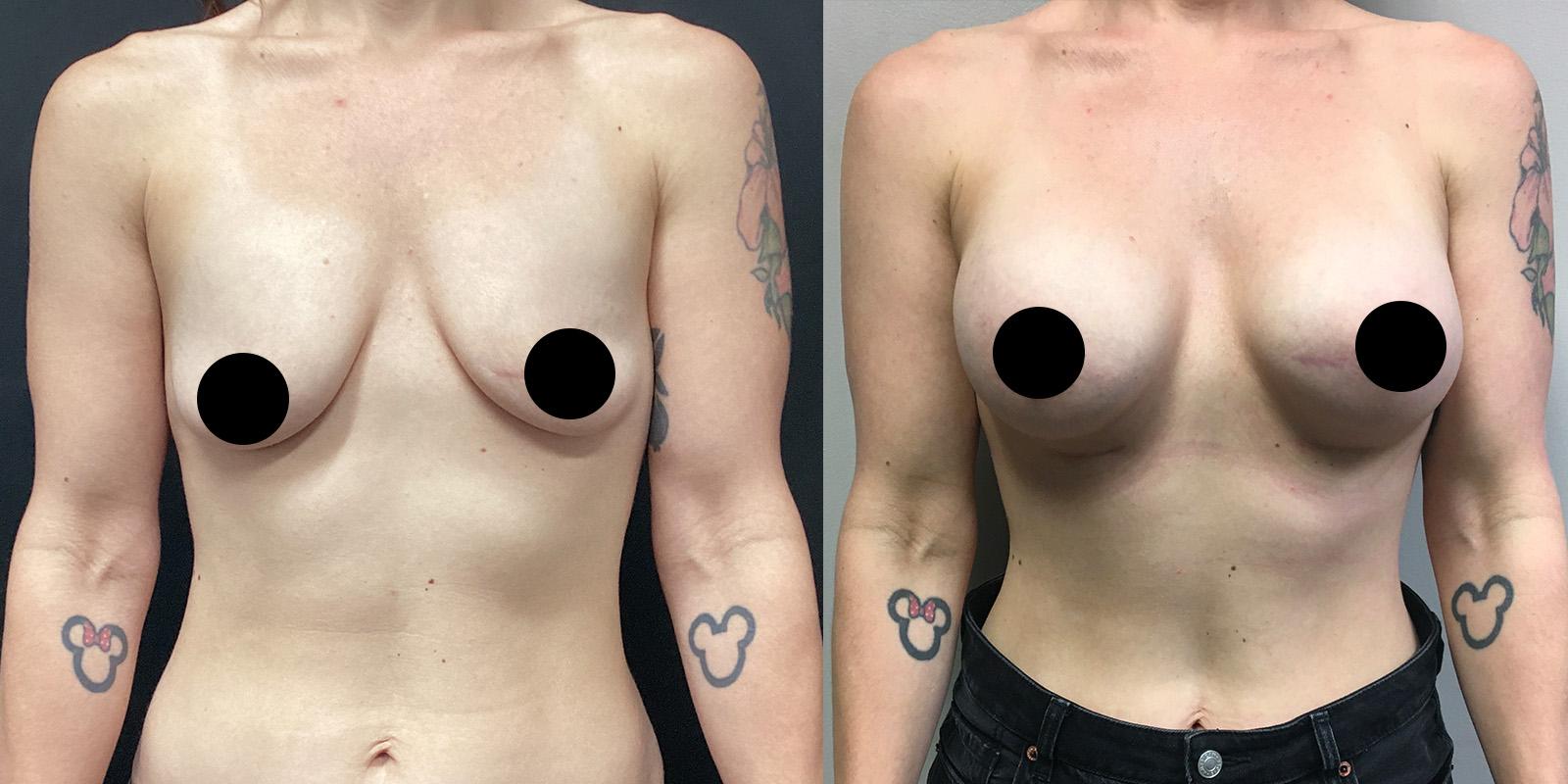 Dual-Plane-Breat-Augmentation-Before-after-case-03-new
