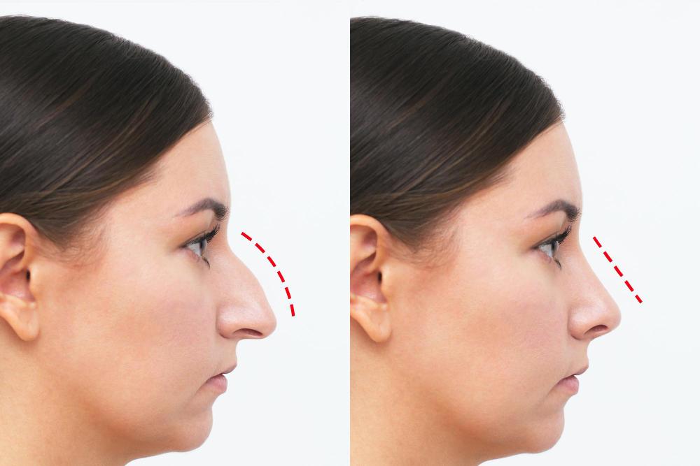 Modal showing Septorhinoplasty Surgery