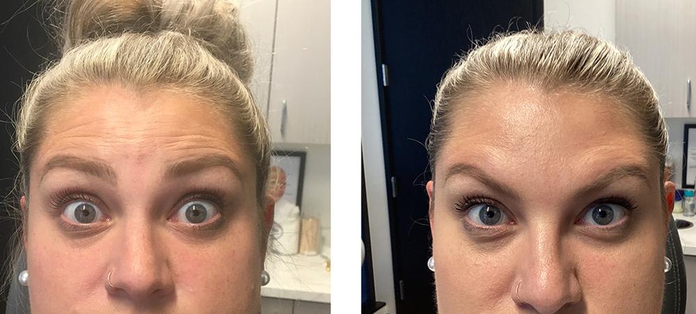 Botox Before After