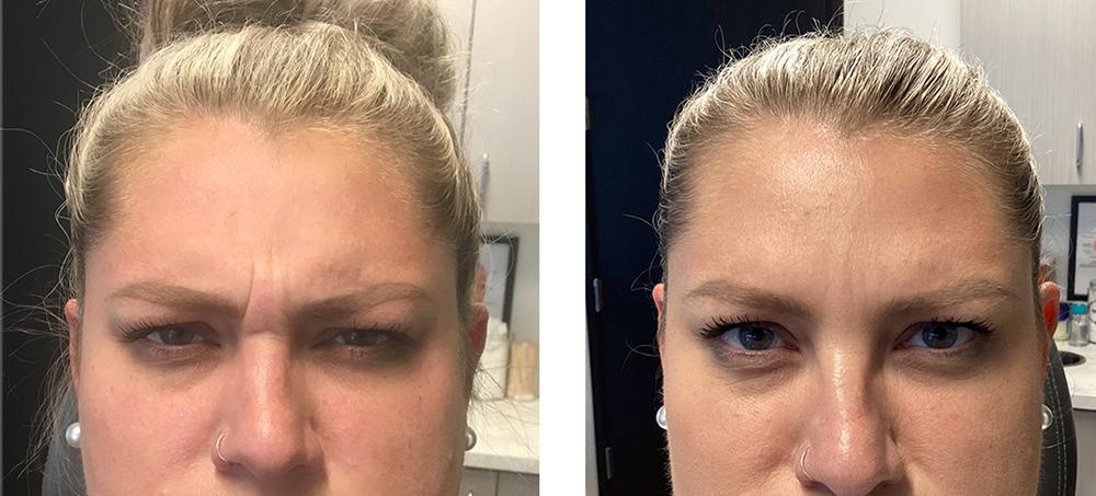 Botox Before After