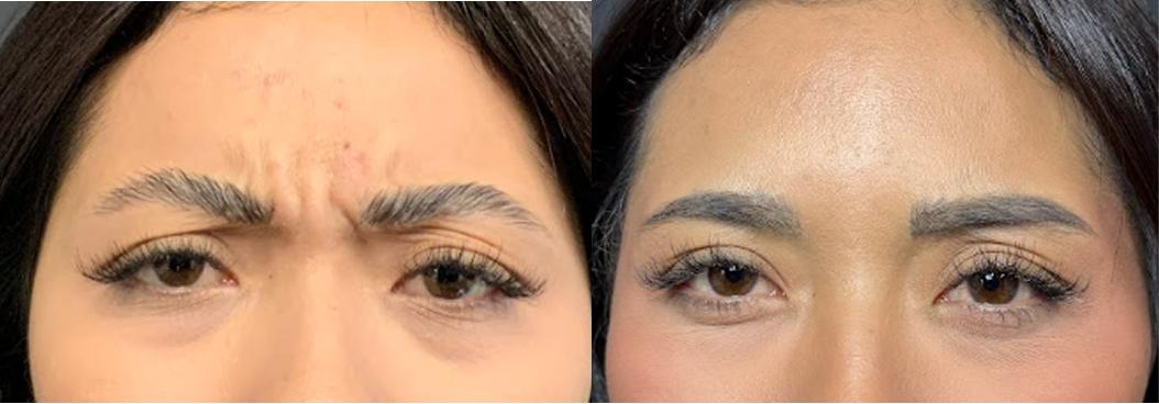 Dysport Before After