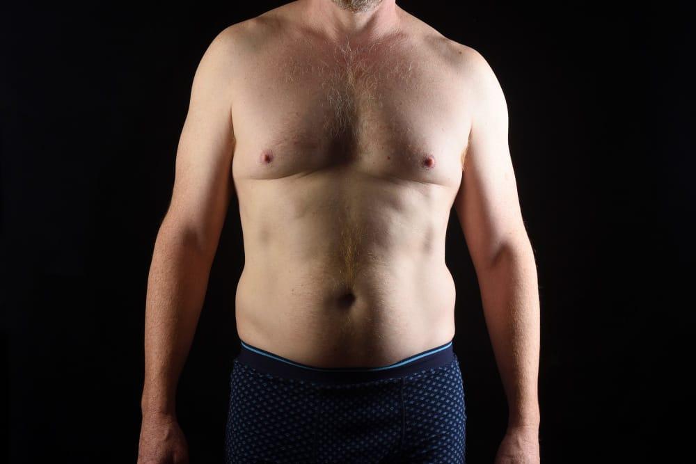 Why Men Need Gynecomastia Revision Surgery