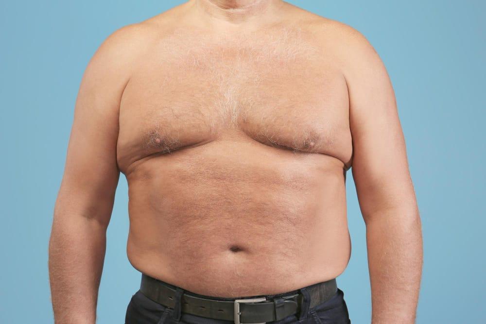 Gynecomastia Sps