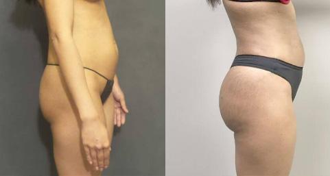 Bbl Revision Sps Before After