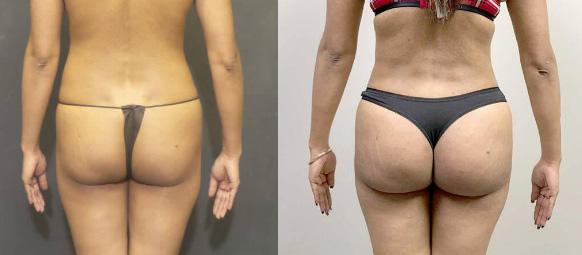 Bbl Revision Sps Before After