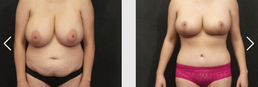 Breast Lift Before and After Patient image