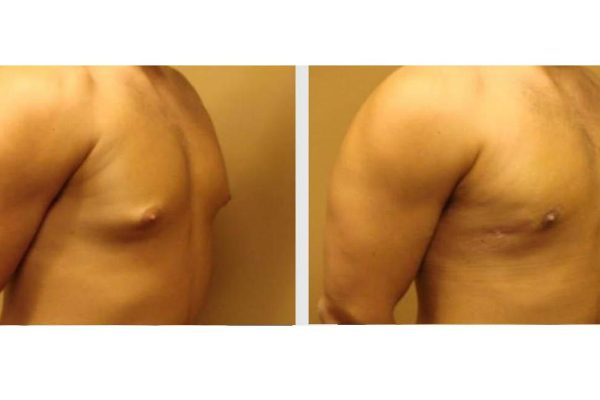 Gynecomastia Before and After Photos-02