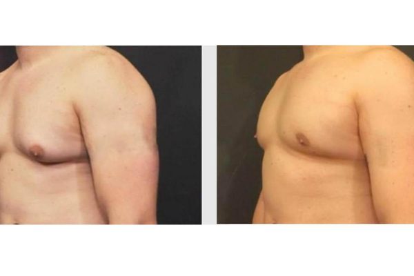 Gynecomastia Before and After Photos