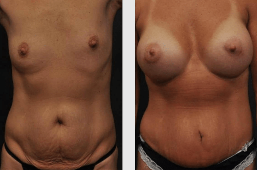 Mommy Makeover Before and After Case 01