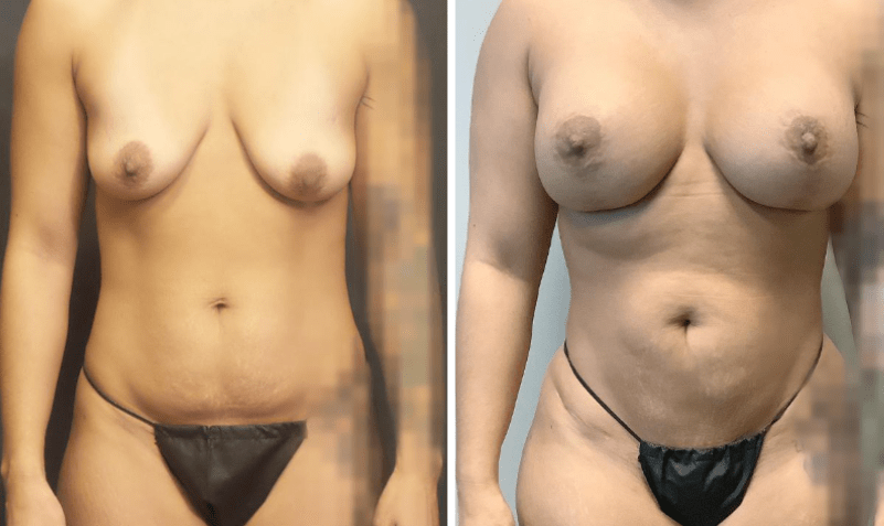 Mommy Makeover Before and After Case 22