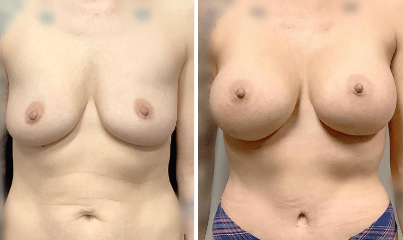 Mommy Makeover Before and After Case 27