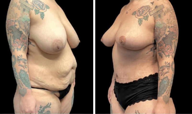 Mommy Makeover Before and After Case 28