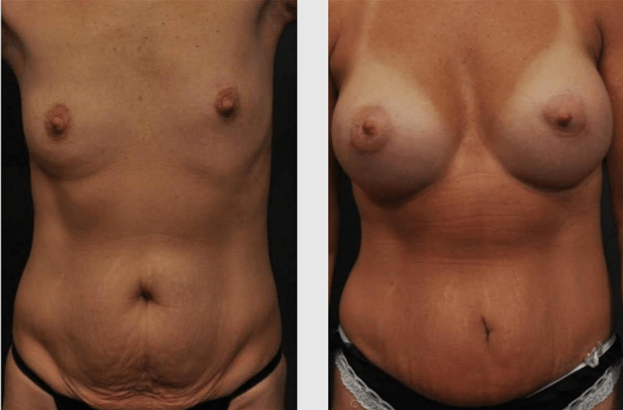 Mommy Makeover Before and After Result