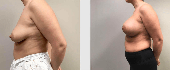 Breast-Augmentation-with-Lift