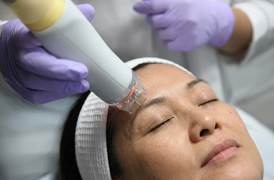 What Is Cutera Secret RF Microneedling?