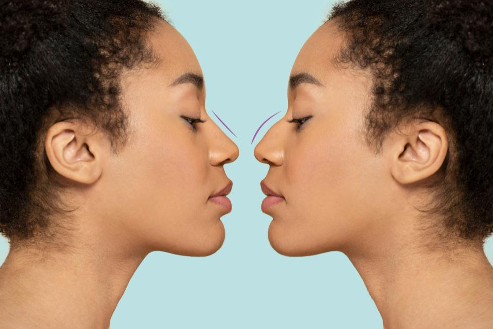 Rhinoplasty Cost in Seattle