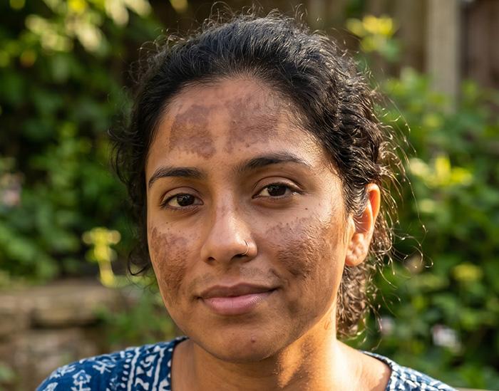 can glutathione cure melasma Best Treatments Atlanta & Sandy Springs, GA All About Melasma Saikia