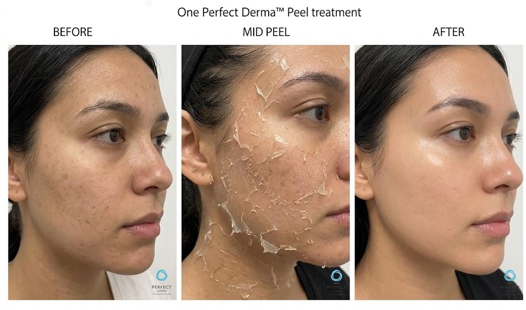glutathione peel side effects IV Drip: Cost, Benefits, Procedure & The Perfect Derma Peel in