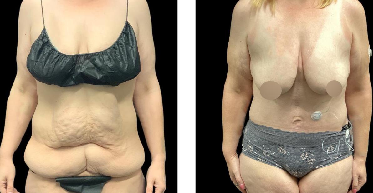 where to inject semaglutide after tummy tuck Fleur De Lis Seattle And Tacoma Where to Inject Semaglutide: Optimal