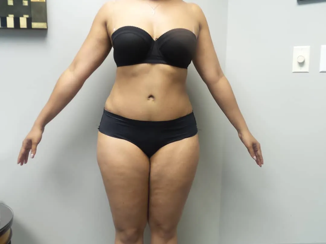 Tummy Tuck
