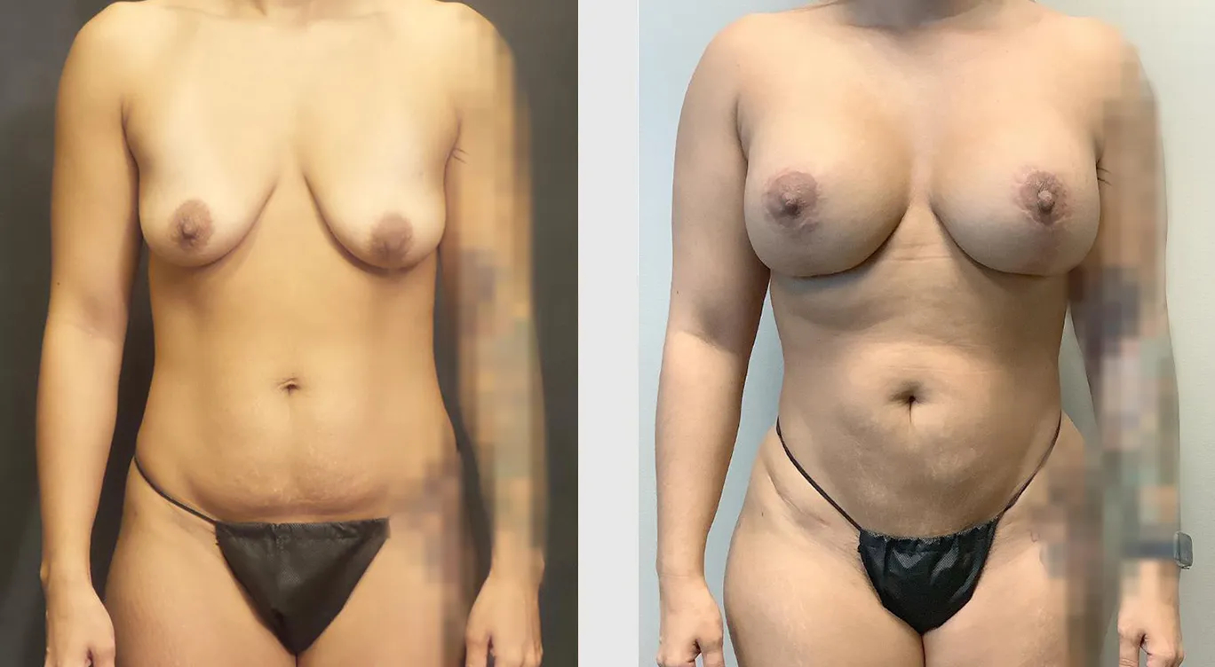 Before and After 01