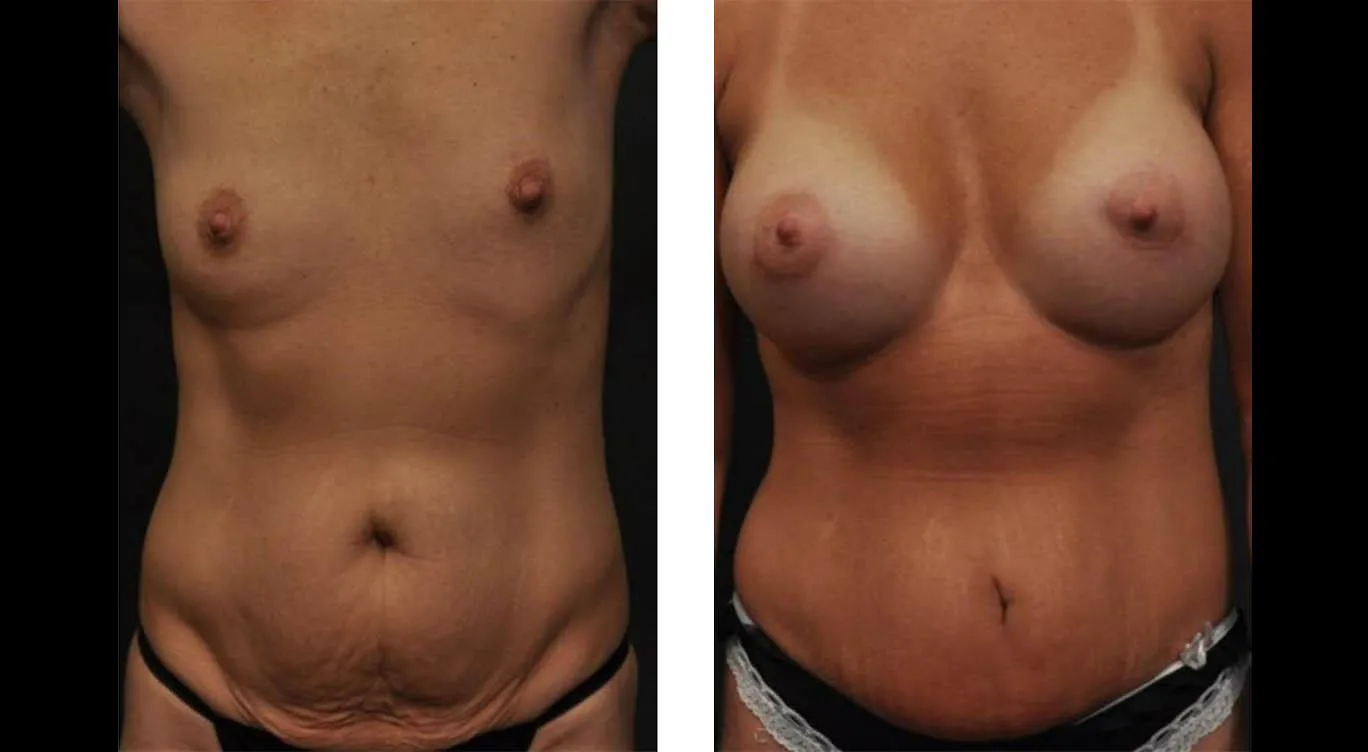 Before and After 04