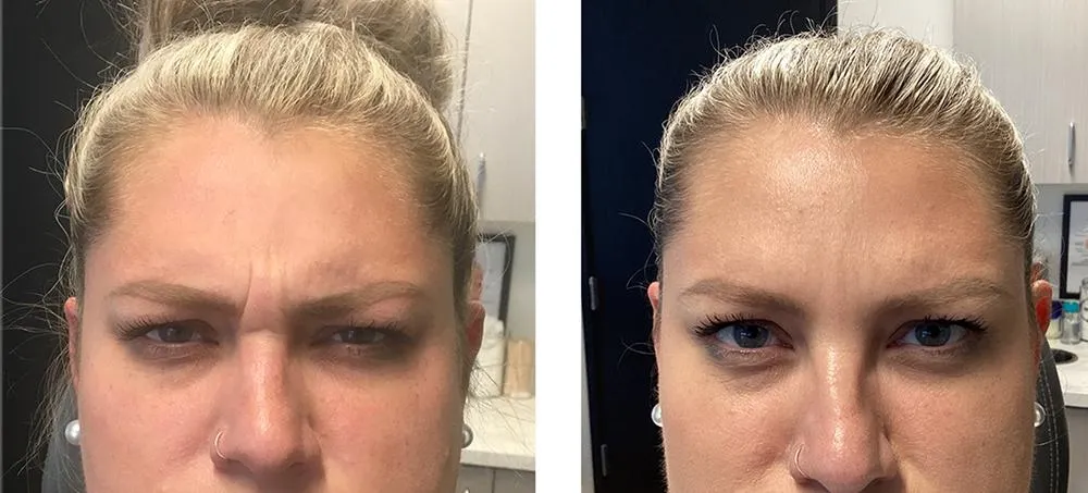 botox-before-after-10