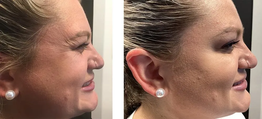 botox-before-after-11