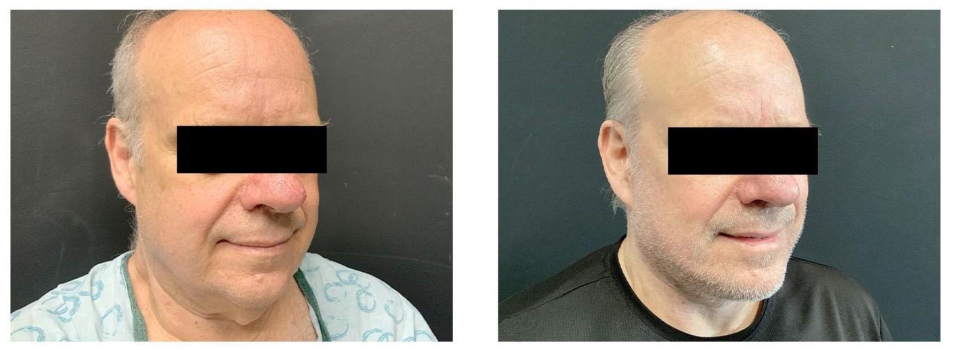 Facelift Before and after image