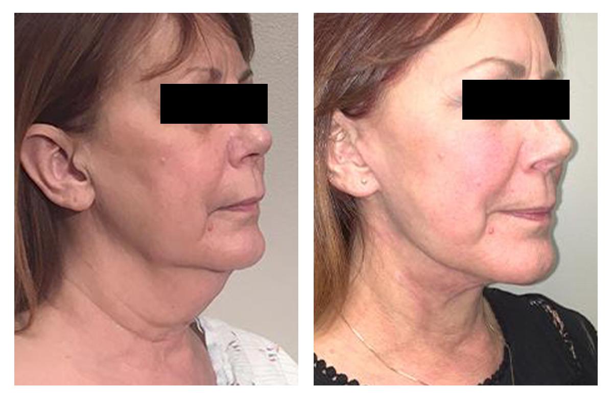 Facelift Before and after photo